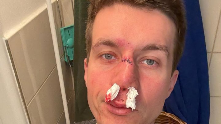 Daniel Krejčík upadl na obličej a ublížil si. 